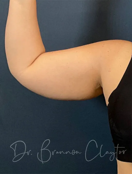 arm-lift-49951a-right-before-claytor