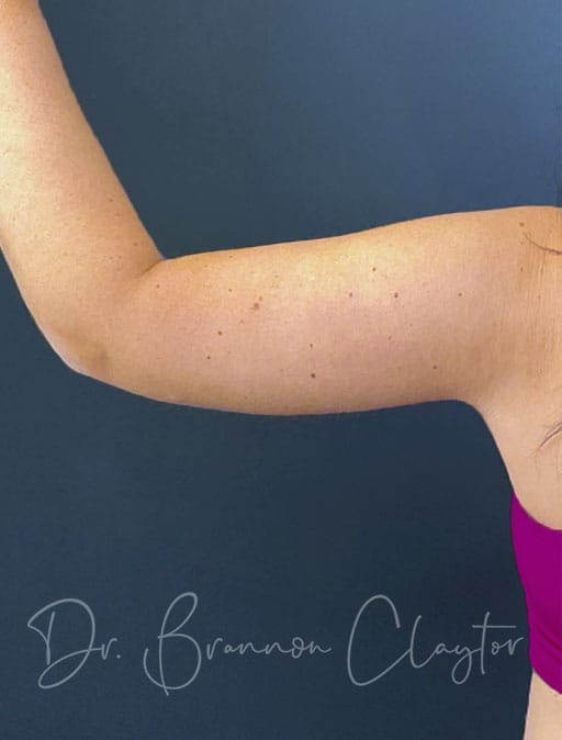 Arm Lift