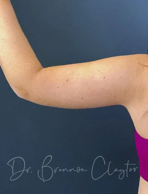 Arm Lift