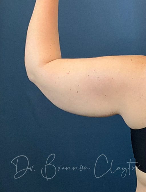 Arm Lift