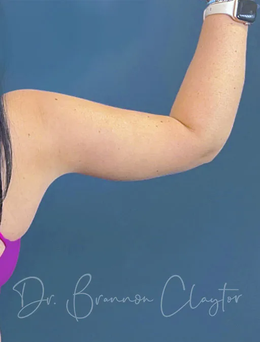 arm-lift-49951d-right-after-claytor