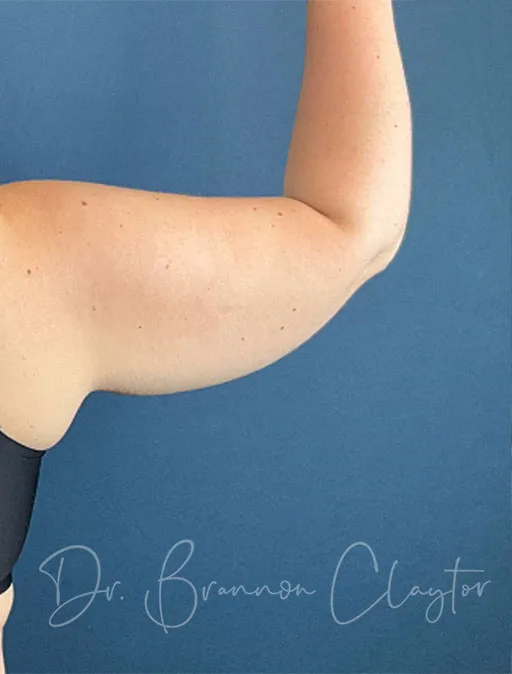 arm-lift-49951d-right-before-claytor