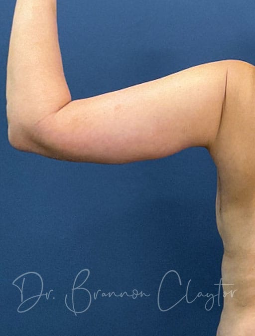 Arm Lift