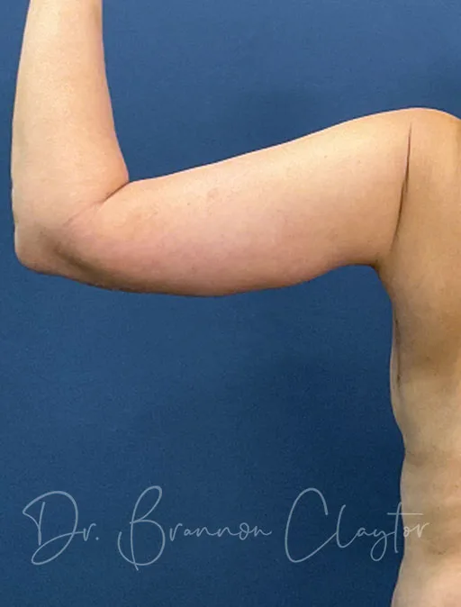 Arm Lift