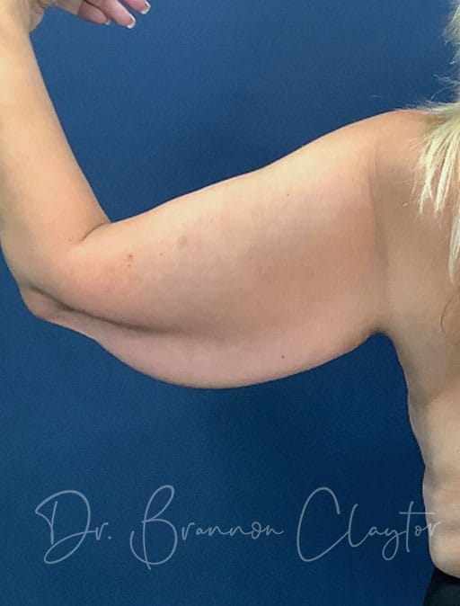 Arm Lift
