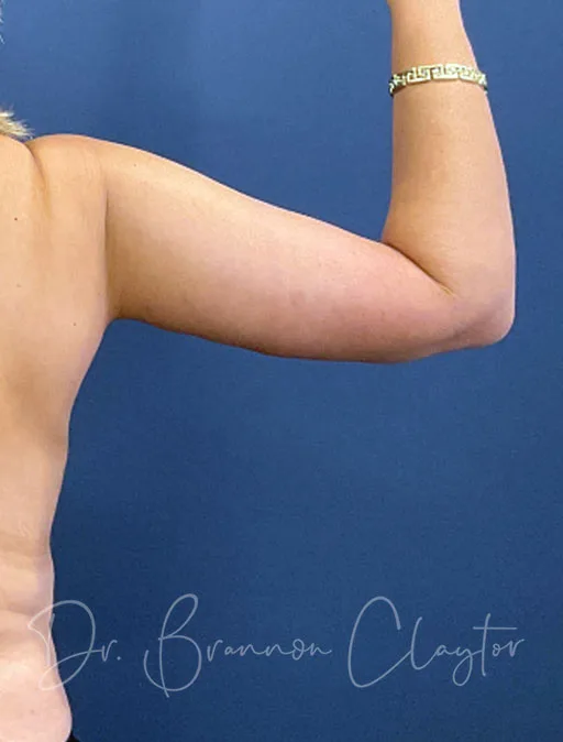 arm-lift-49990d-right-after-claytor