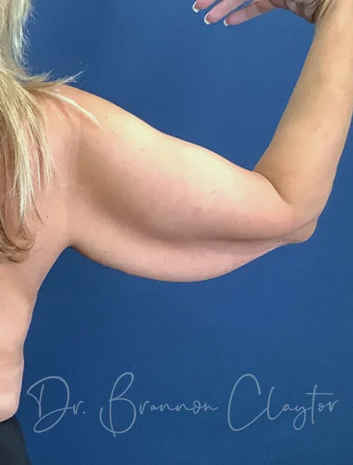 arm-lift-49990d-right-before-claytor