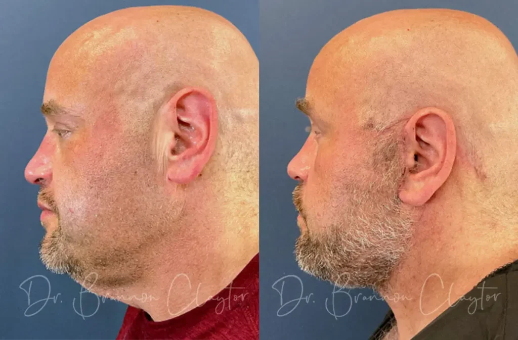 Deep Plane Facelift Before and After Patient