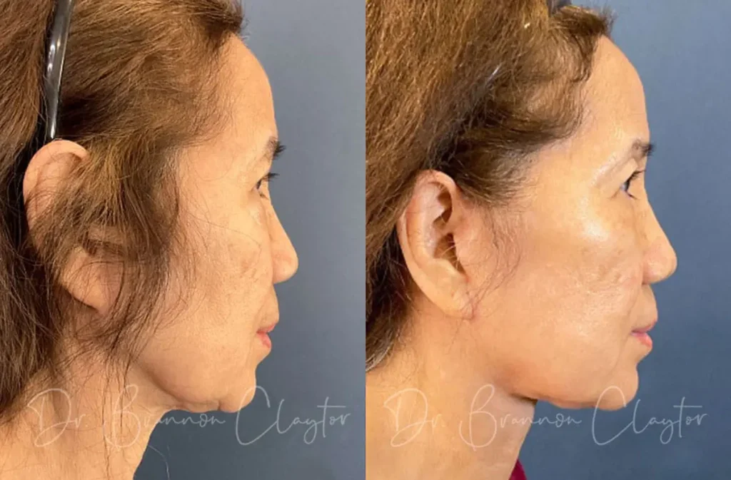 Deep Plane Facelift Before and After Patient
