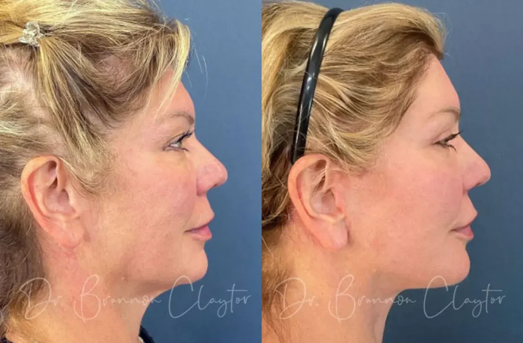 Deep Plane Facelift Before and After Patient