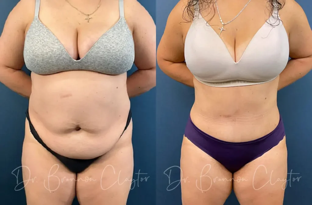 Drainless Tummy Tuck Before and After Patient