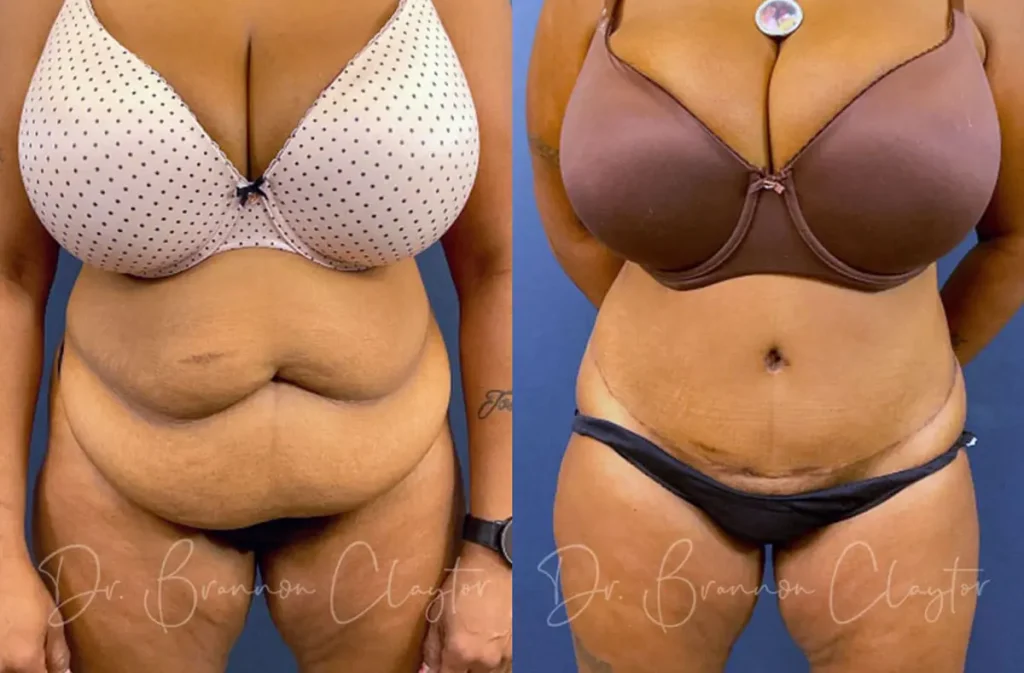 Drainless Tummy Tuck Before and After Patient