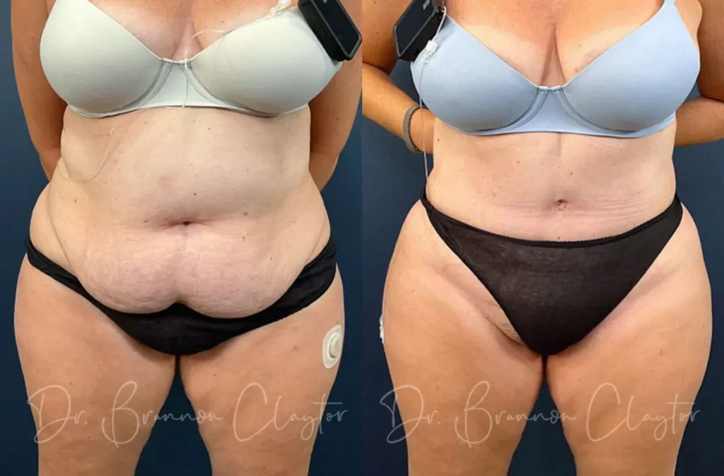 Drainless Tummy Tuck Before and After Patient