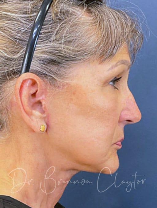 Deep Plane Facelift, Neck Lift