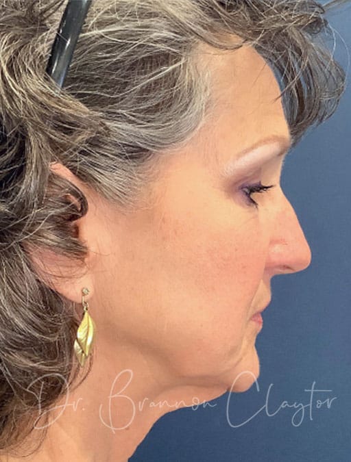 Deep Plane Facelift, Neck Lift