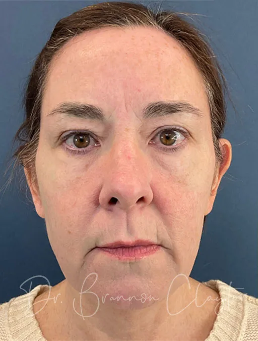 facelift-necklift-upper-eyes-52409a-before-claytor