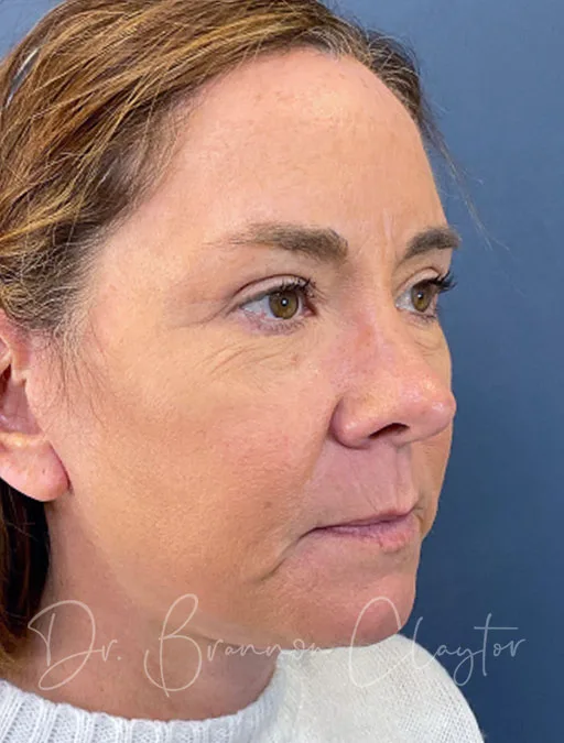 facelift-necklift-upper-eyes-52409b-after-claytor