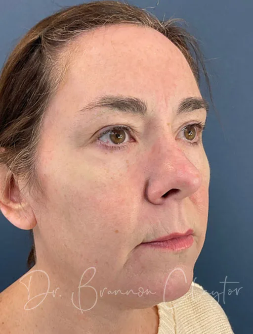facelift-necklift-upper-eyes-52409b-before-claytor