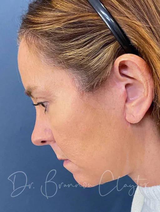 facelift-necklift-upper-eyes-52409d-after-claytor