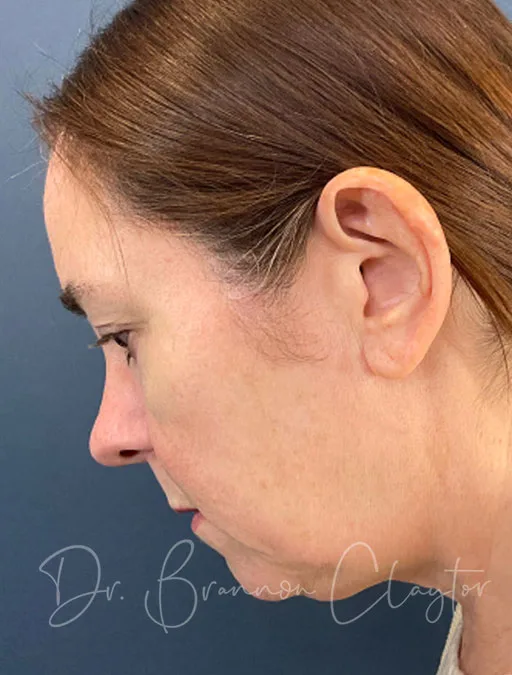 facelift-necklift-upper-eyes-52409d-before-claytor
