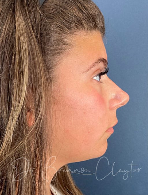 Rhinoplasty & Septoplasty