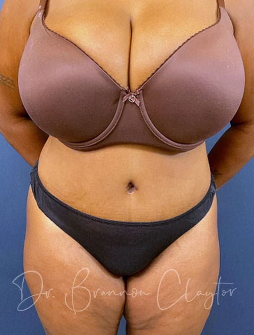 Drainless Tummy Tuck