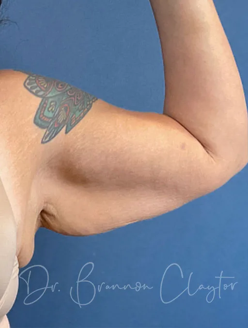 arm-lift-50804a-leftt-before-claytor
