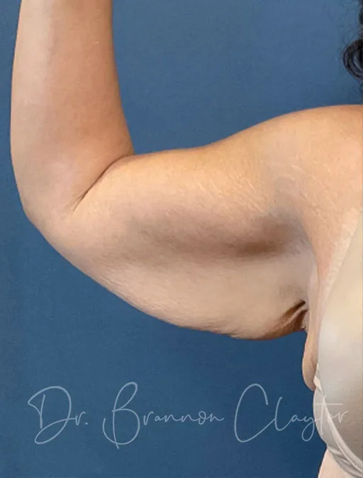 arm-lift-50804a-right-before-claytor