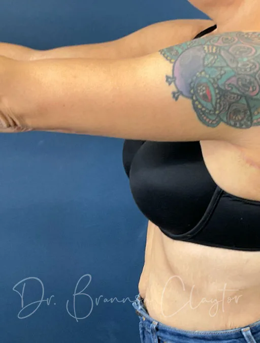 arm-lift-50804c-after-claytor