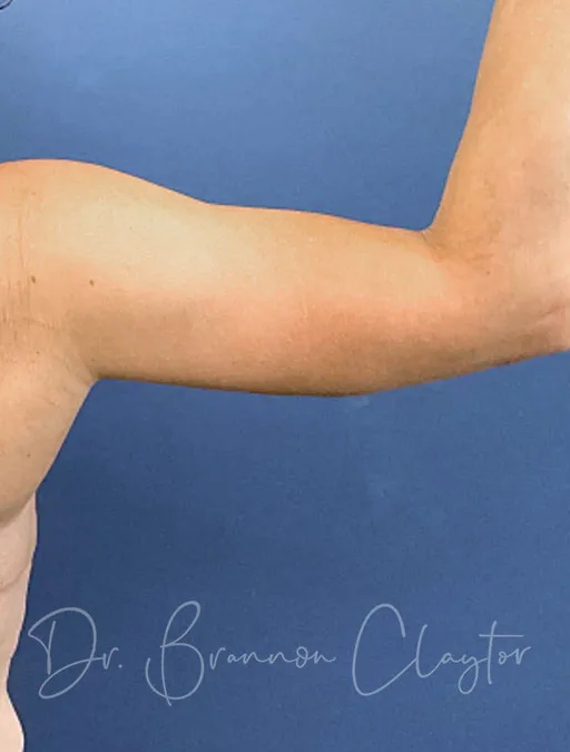 arm-lift-50804d-right-after-claytor