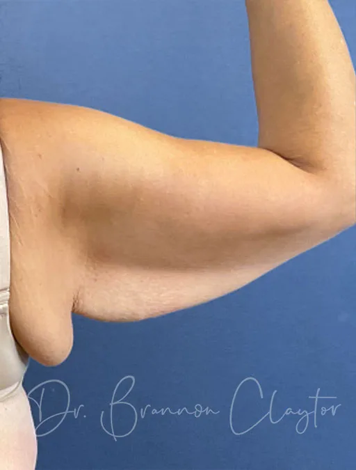 arm-lift-50804d-right-before-claytor