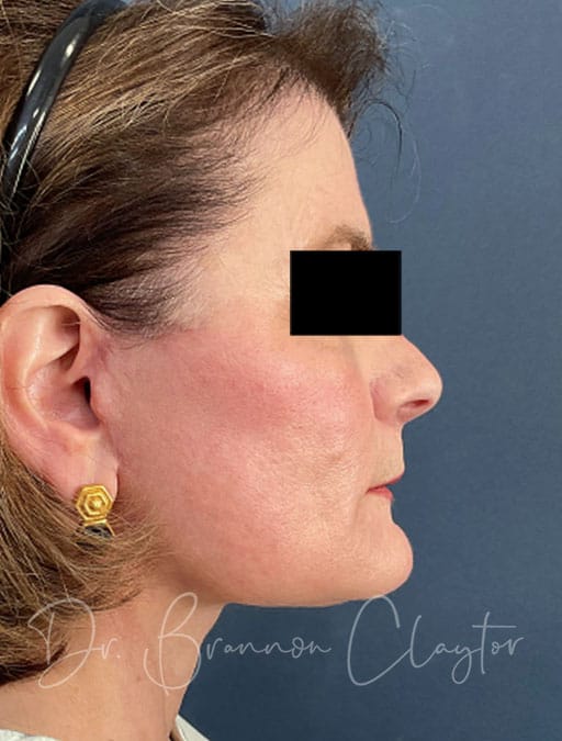 Deep Plane Facelift, Neck Lift