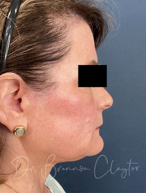 Deep Plane Facelift, Neck Lift