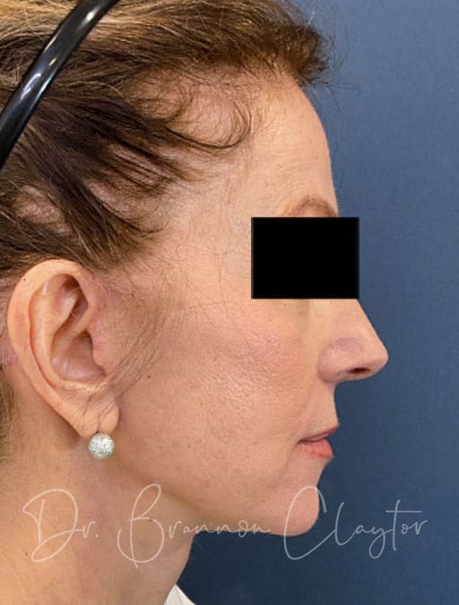 Deep Plane Facelift, Neck Lift