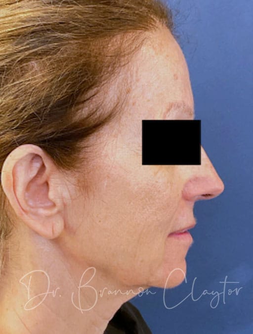 Deep Plane Facelift, Neck Lift