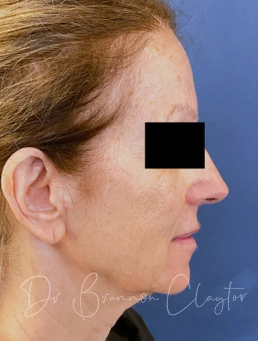 Deep Plane Facelift, Neck Lift