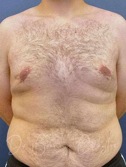 Male Breast Reduction