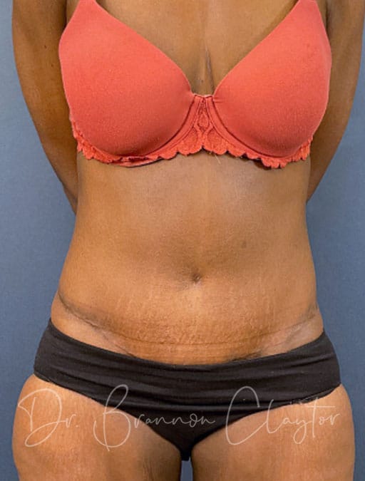 Drainless Tummy Tuck