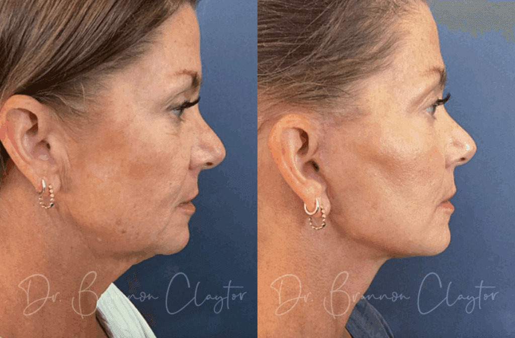Before and after deep plane facelift, neck lift, and CO2 with Philadelphia plastic surgeon Dr. R. Brannon Claytor
