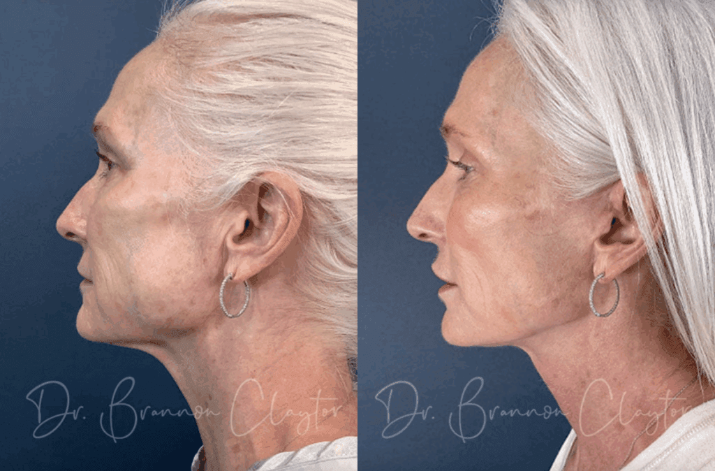 Before and after a MyEllevate neck lift with Dr. Claytor