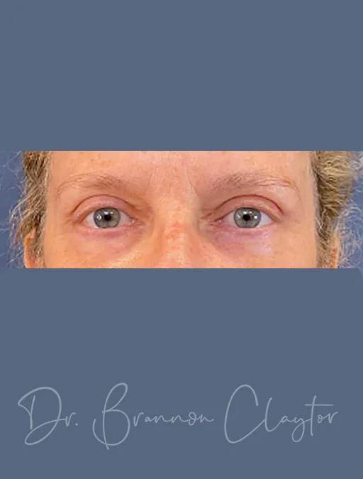 Upper & Lower Blepharoplasty