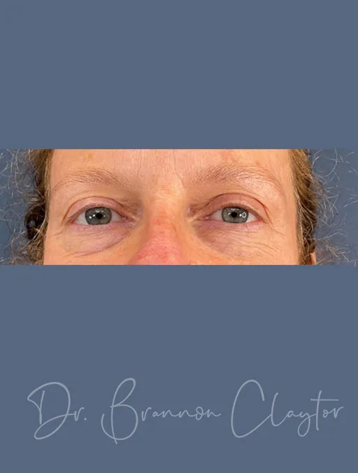 Upper & Lower Blepharoplasty