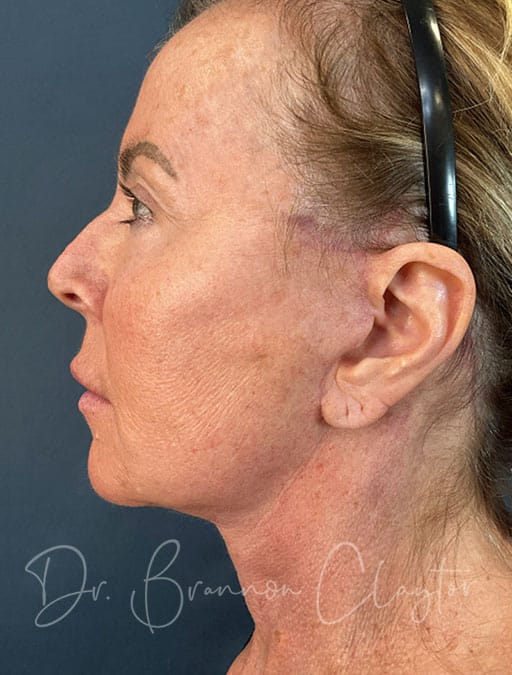 Deep Plane Facelift, Neck Lift, & Eyelid Lift