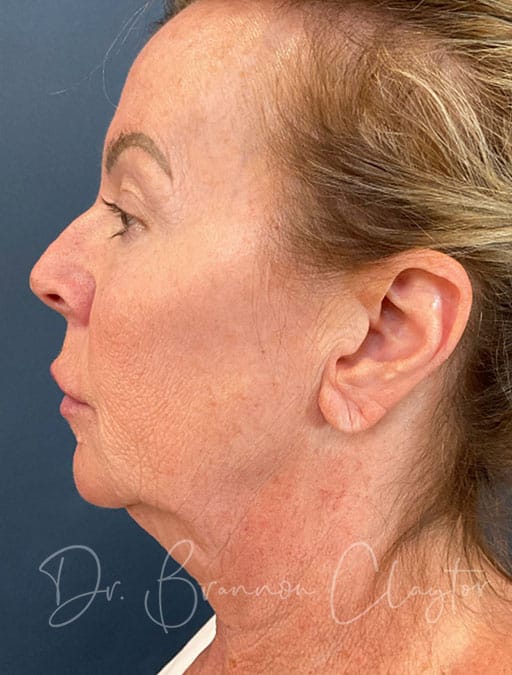 Deep Plane Facelift, Neck Lift, & Eyelid Lift