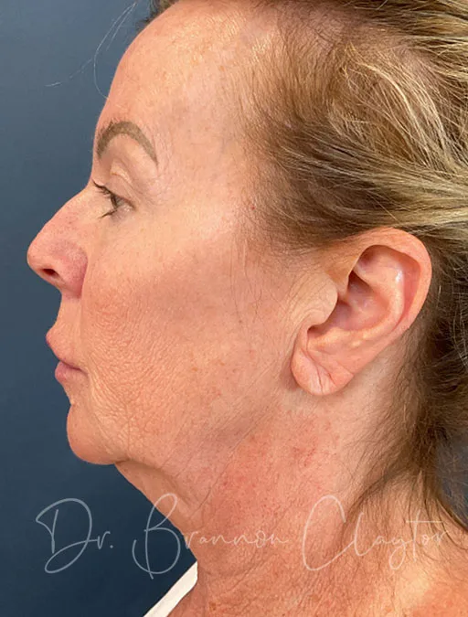 Deep Plane Facelift, Neck Lift, & Eyelid Lift