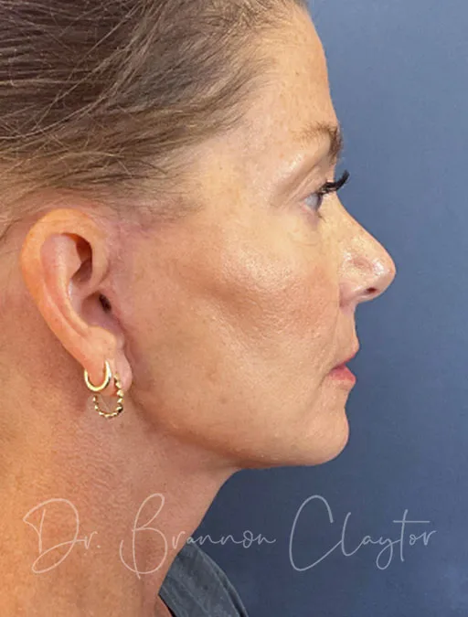 Deep Plane Facelift, Neck Lift, CO2 Laser