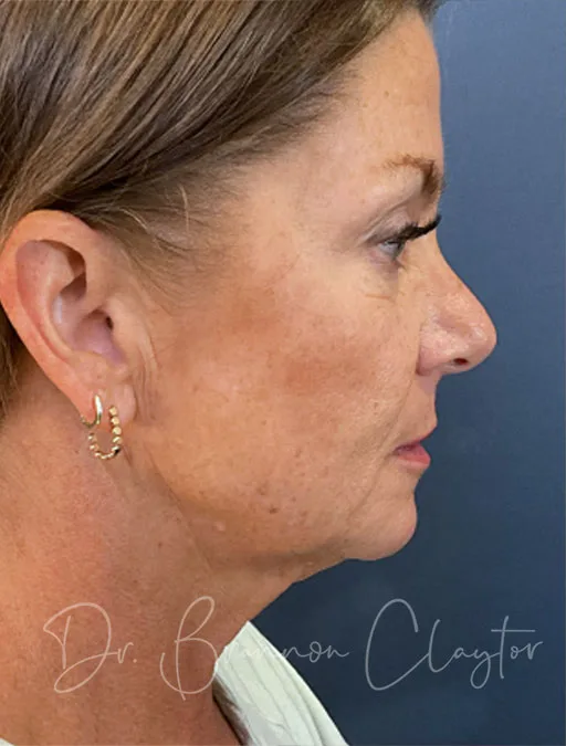 Deep Plane Facelift, Neck Lift, CO2 Laser