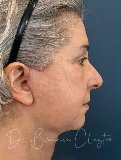 Deep Plane Facelift, Neck Lift, & Eyelid Lift