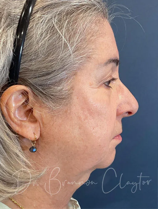 Deep Plane Facelift, Neck Lift, & Eyelid Lift