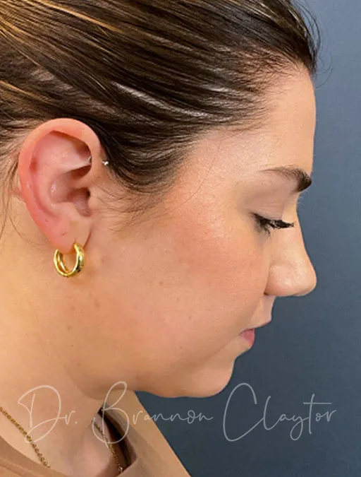 MyEllevate Neck Lift